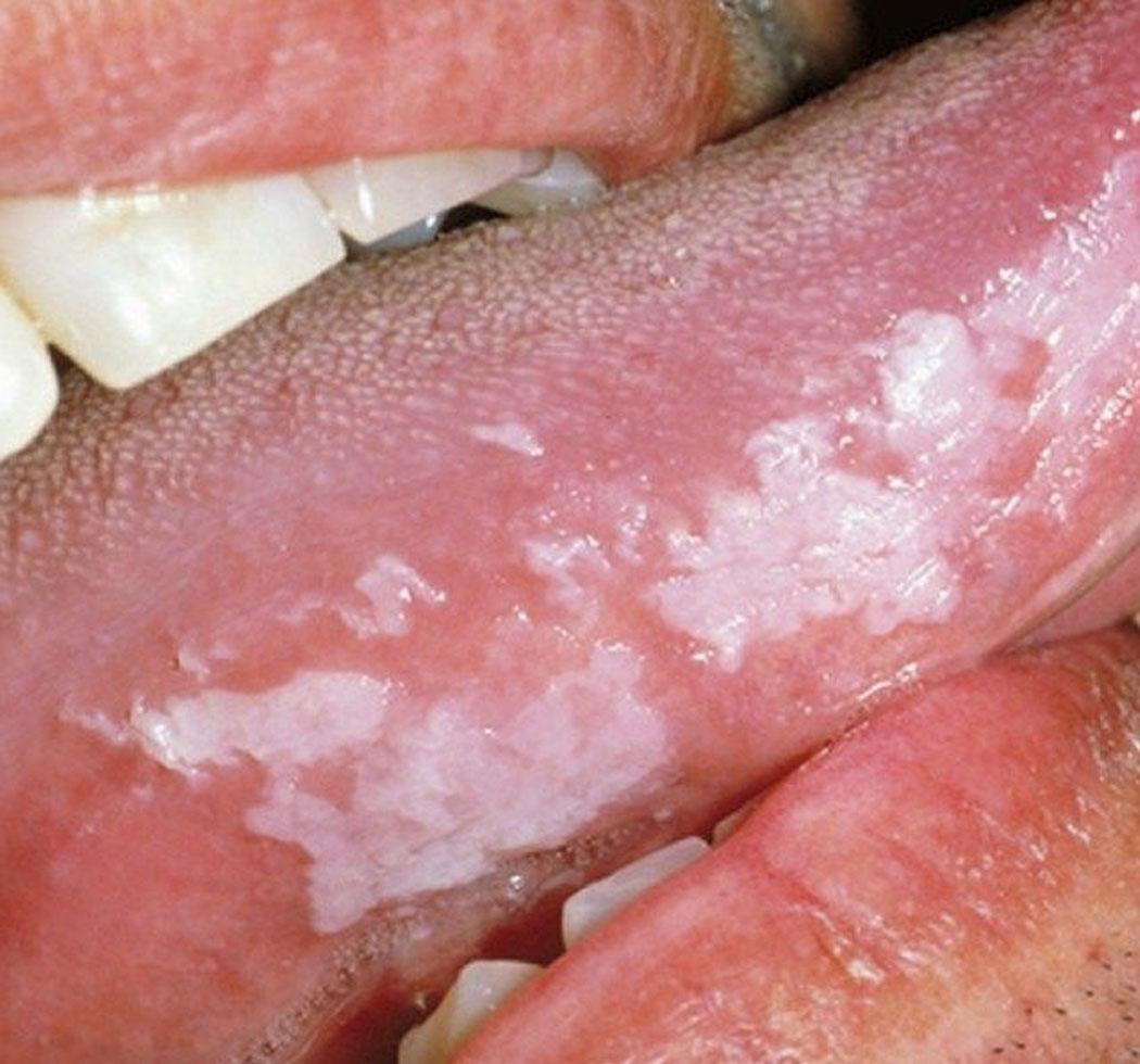 Mouth Infected by Oral Cancer